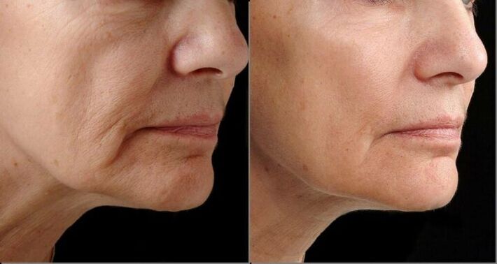 Koža obraza pred in po postopku laserskega pomlajevanja