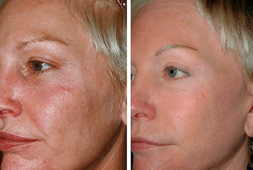slika pred in po delnem pomlajevanju kože 1