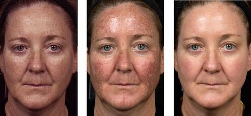 slika pred in po delnem pomlajevanju kože 2