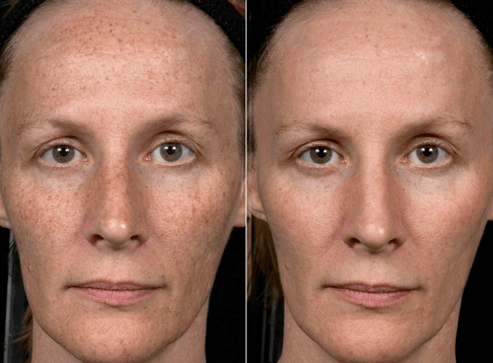 slika pred in po delnem pomlajevanju kože 3