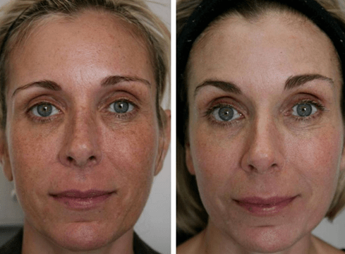 slika pred in po delnem pomlajevanju kože 4