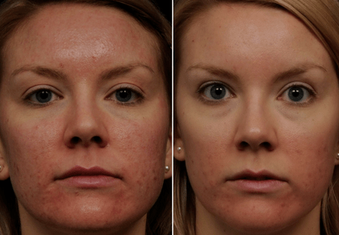 slika pred in po delnem pomlajevanju kože 6