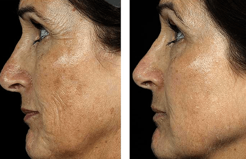 slika pred in po delnem pomlajevanju kože 7