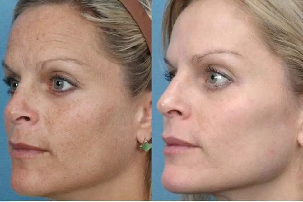 slika pred in po strojnem pomlajevanju kože 1