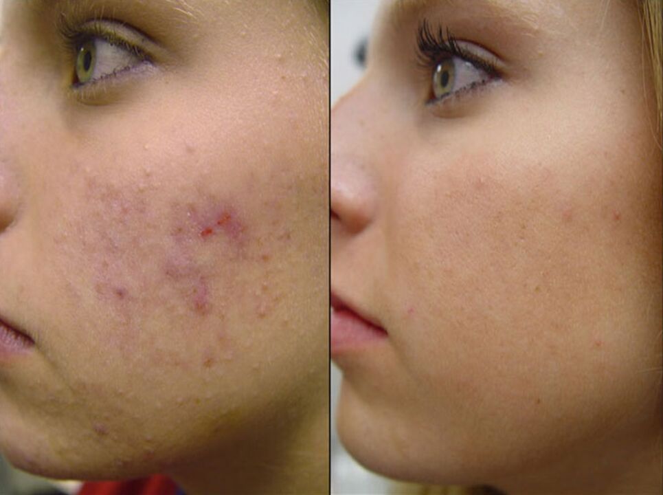 slika pred in po strojnem pomlajevanju kože 2