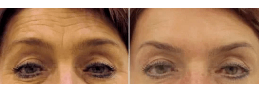 naprave za delno pomlajevanje