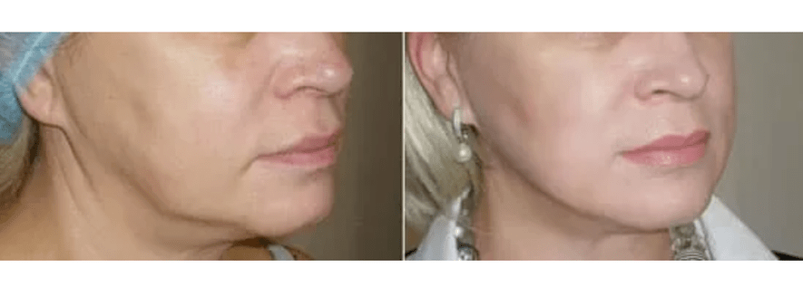 okrevanje po pomlajevanju kože